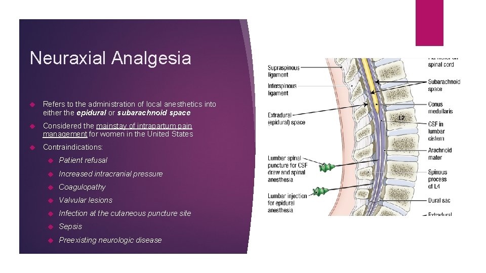 Neuraxial Analgesia Refers to the administration of local anesthetics into either the epidural or