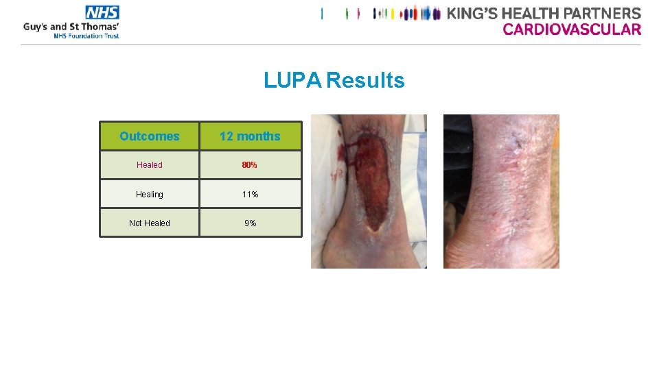 LUPA Results Outcomes 12 months Healed 80% Healing 11% Not Healed 9% 