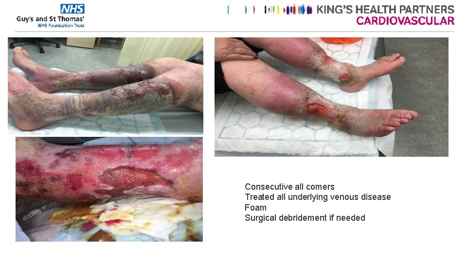 Consecutive all comers Treated all underlying venous disease Foam Surgical debridement if needed 