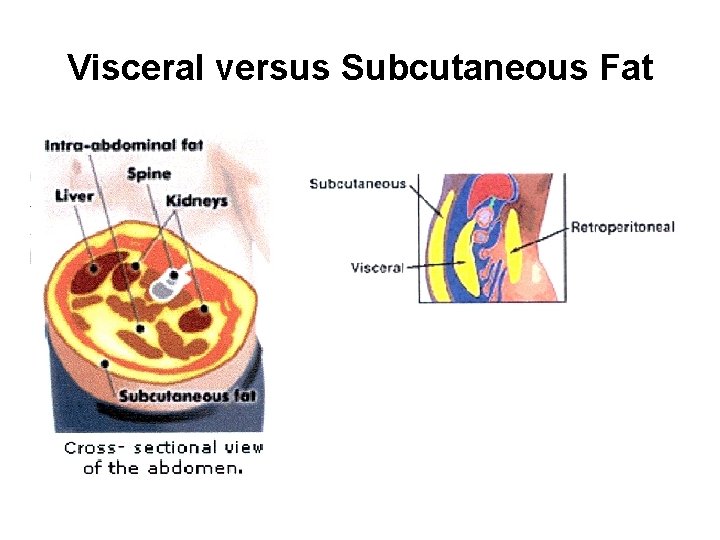 Visceral versus Subcutaneous Fat 