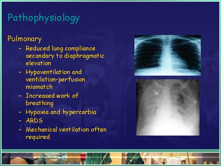 Pathophysiology Pulmonary – Reduced lung compliance secondary to diaphragmatic elevation – Hypoventilation and ventilation-perfusion