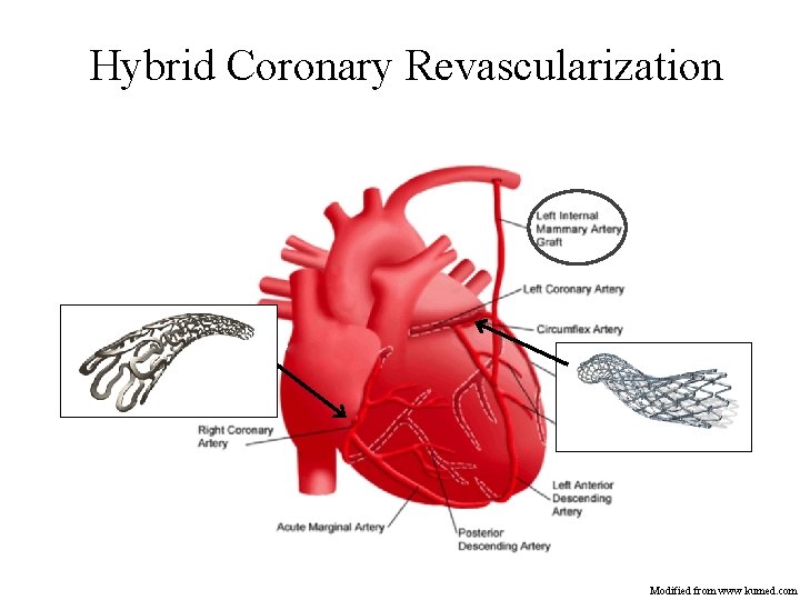 Hybrid Coronary Revascularization Modified from www. kumed. com 
