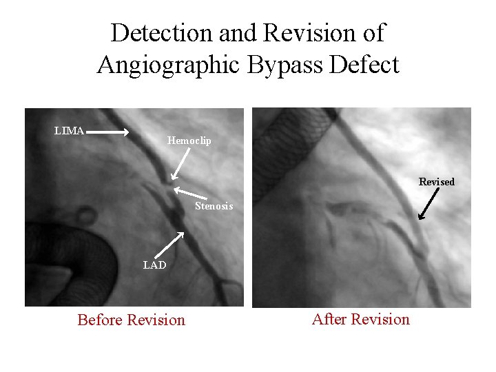 Detection and Revision of Angiographic Bypass Defect LIMA Hemoclip Revised Stenosis LAD Before Revision