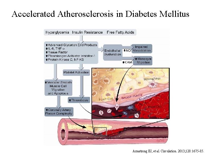 Accelerated Atherosclerosis in Diabetes Mellitus Armstrong EJ, et al. Circulation. 2013; 128: 1675 -85.