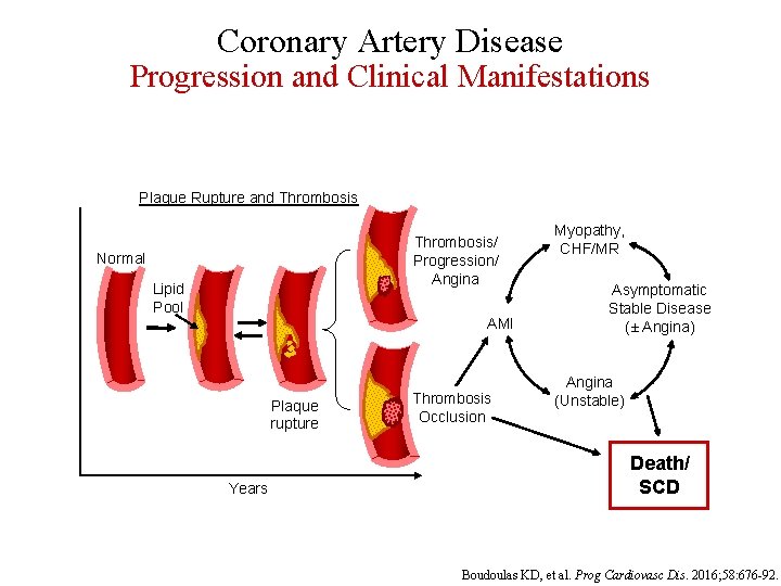 Coronary Artery Disease Progression and Clinical Manifestations Plaque Rupture and Thrombosis/ Progression/ Angina Normal