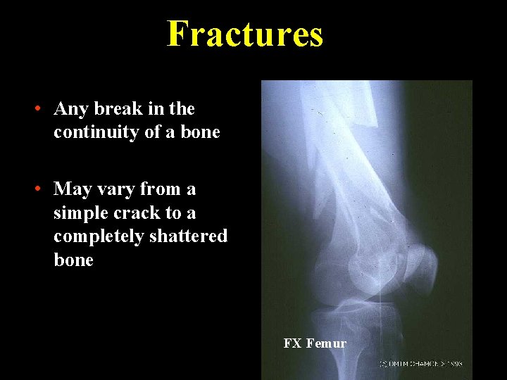 Fractures • Any break in the continuity of a bone • May vary from