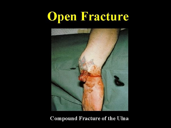 Open Fracture Compound Fracture of the Ulna 