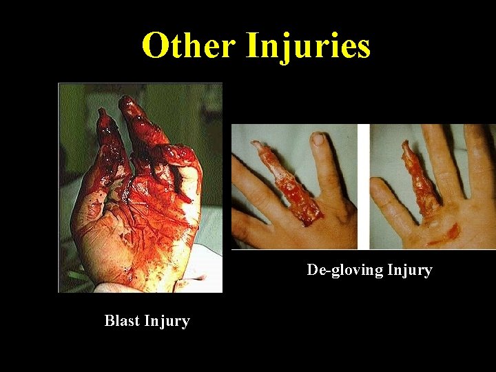Other Injuries De-gloving Injury Blast Injury 