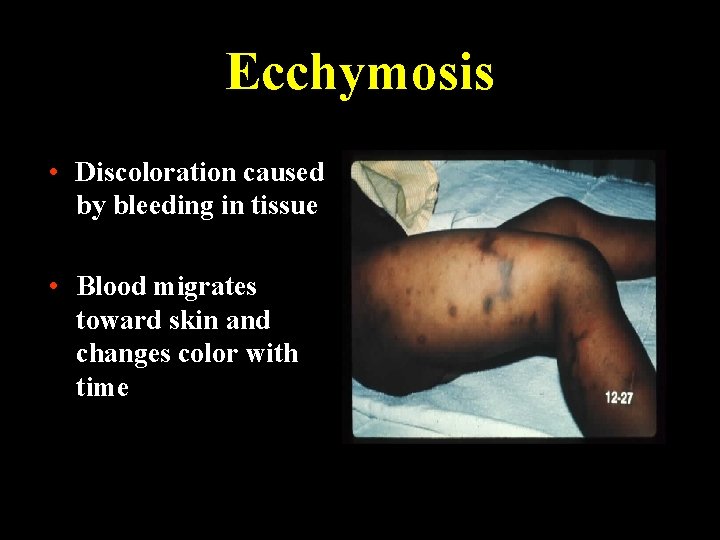 Ecchymosis • Discoloration caused by bleeding in tissue • Blood migrates toward skin and