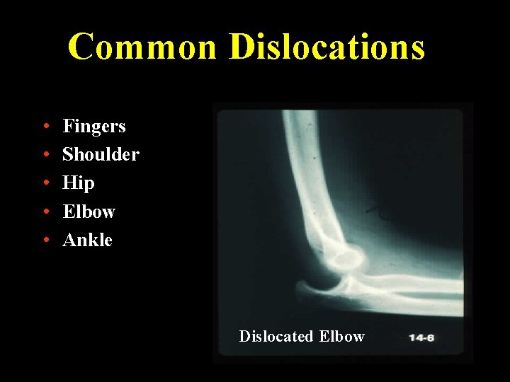 Common Dislocations • • • Fingers Shoulder Hip Elbow Ankle Dislocated Elbow 