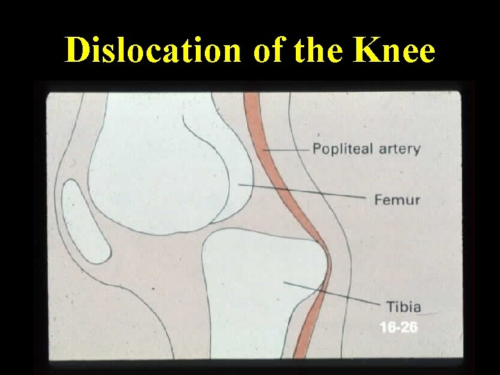 Dislocation of the Knee 