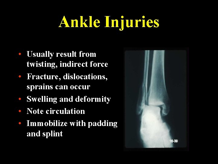 Ankle Injuries • Usually result from twisting, indirect force • Fracture, dislocations, sprains can