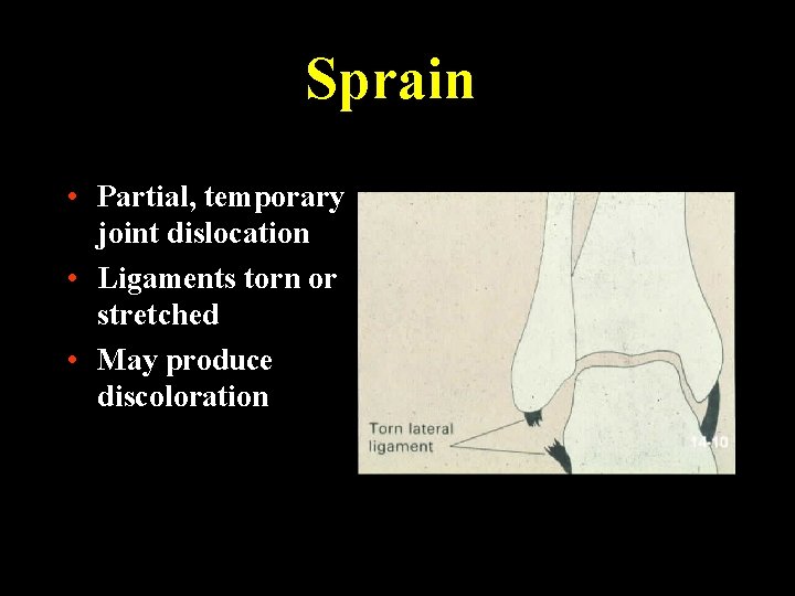 Sprain • Partial, temporary joint dislocation • Ligaments torn or stretched • May produce
