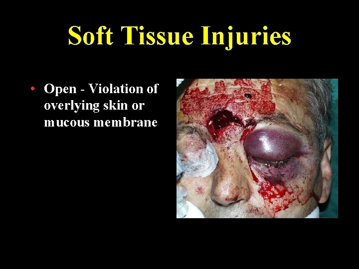 Soft Tissue Injuries • Open - Violation of overlying skin or mucous membrane 