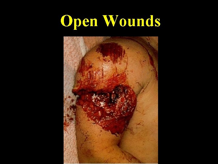 Open Wounds 