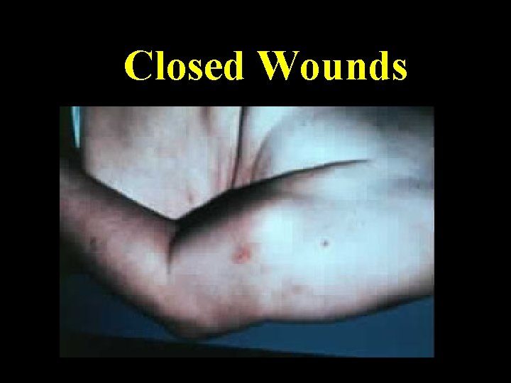 Closed Wounds 