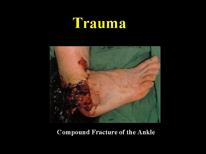Trauma Compound Fracture of the Ankle 