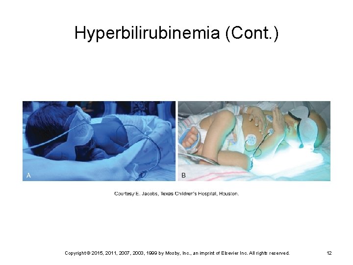 Hyperbilirubinemia (Cont. ) FIG. 8 -12  A, Infant receiving phototherapy; note nested boundaries for comfort
