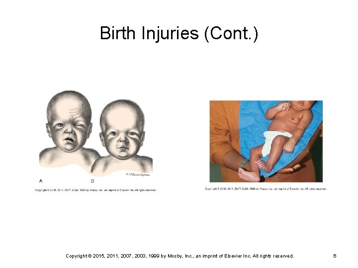 Birth Injuries (Cont. ) FIG. 8 -2  A, Paralysis of right side of face 15