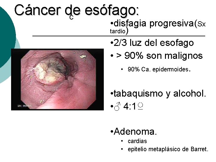 Cáncer de esófago: C • disfagia progresiva(Sx tardío) • 2/3 luz del esofago •