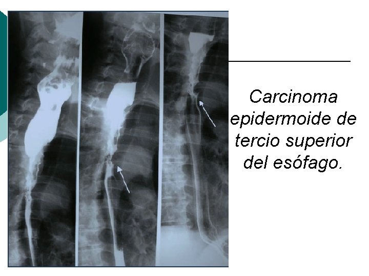 Carcinoma epidermoide de tercio superior del esófago. 