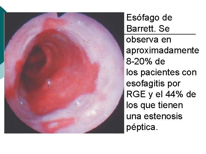 Esófago de Barrett. Se observa en aproximadamente 8 -20% de los pacientes con esofagitis