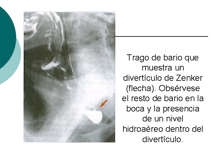 Trago de bario que muestra un divertículo de Zenker (flecha). Obsérvese el resto de