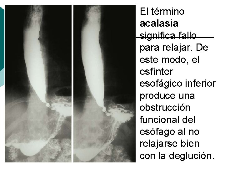 El término acalasia significa fallo para relajar. De este modo, el esfínter esofágico inferior