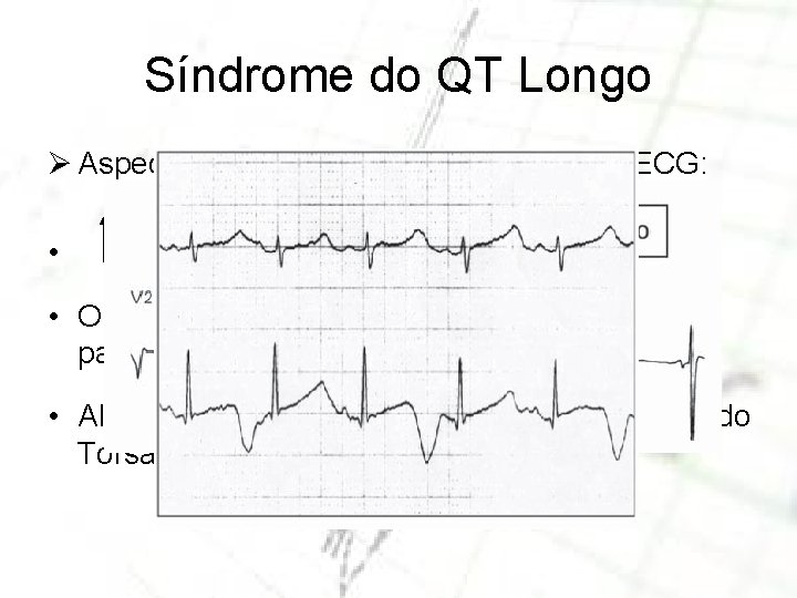 Síndrome do QT Longo Ø Aspectos da Síndrome do QT Longo no ECG: •