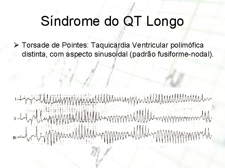 Síndrome do QT Longo Ø Torsade de Pointes: Taquicardia Ventricular polimófica distinta, com aspecto