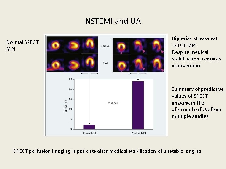 NSTEMI and UA Normal SPECT MPI High-risk stress-rest SPECT MPI Despite medical stabilisation, requires