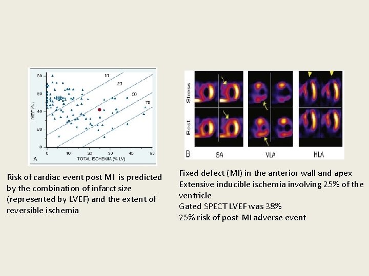 Risk of cardiac event post MI is predicted by the combination of infarct size