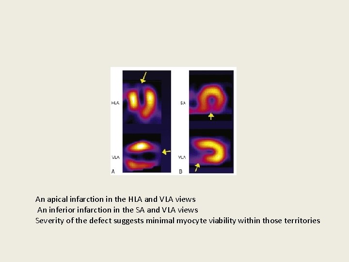 An apical infarction in the HLA and VLA views An inferior infarction in the