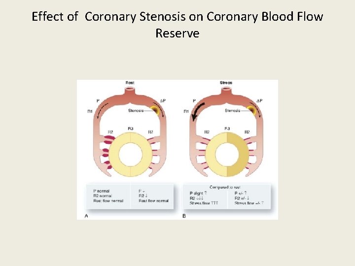 Effect of Coronary Stenosis on Coronary Blood Flow Reserve 