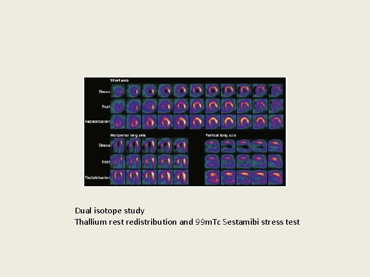 Dual isotope study Thallium rest redistribution and 99 m. Tc Sestamibi stress test 