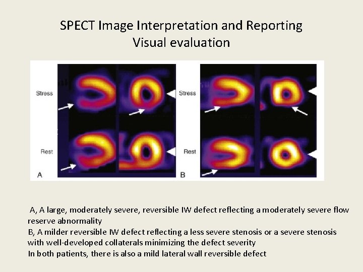 SPECT Image Interpretation and Reporting Visual evaluation A, A large, moderately severe, reversible IW