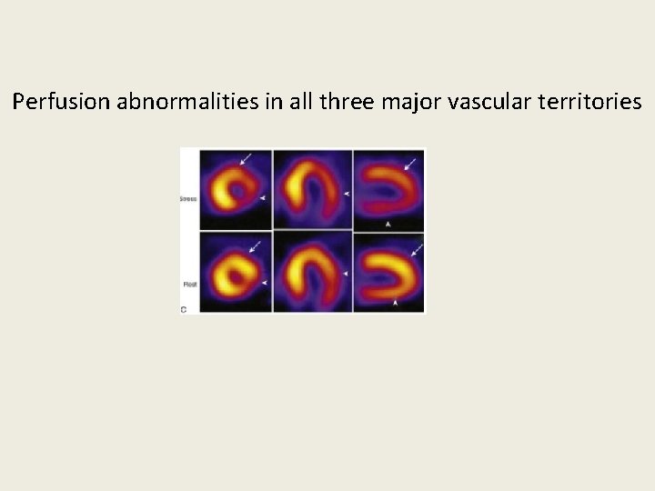 Perfusion abnormalities in all three major vascular territories 