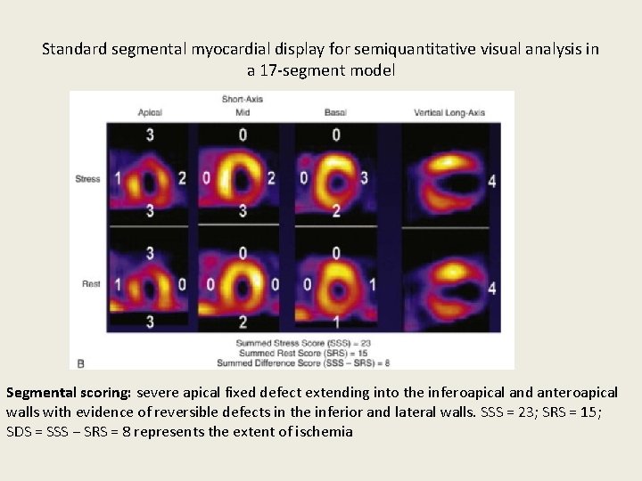 Standard segmental myocardial display for semiquantitative visual analysis in a 17 -segment model Segmental