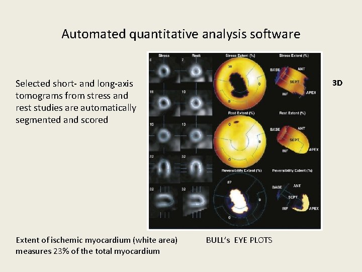 Automated quantitative analysis software Selected short- and long-axis tomograms from stress and rest studies