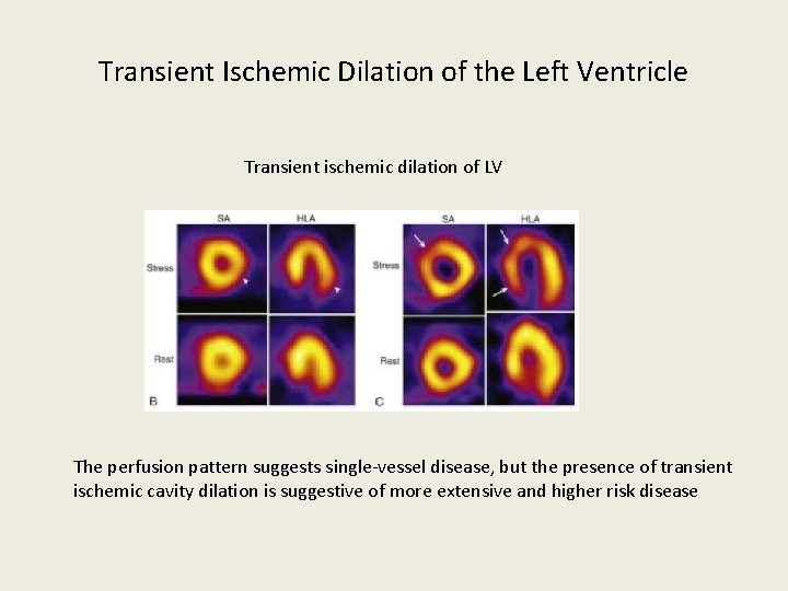 Transient Ischemic Dilation of the Left Ventricle Transient ischemic dilation of LV The perfusion