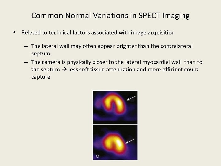 Common Normal Variations in SPECT Imaging • Related to technical factors associated with image