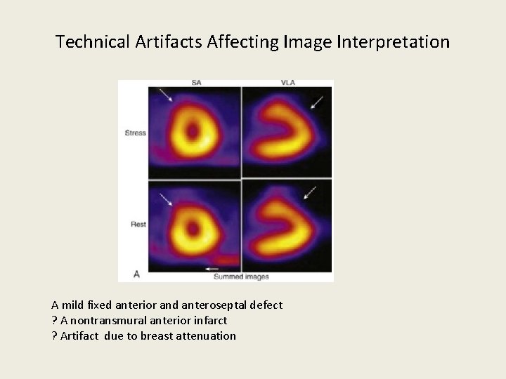 Technical Artifacts Affecting Image Interpretation A mild fixed anterior and anteroseptal defect ? A