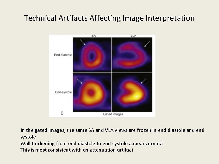 Technical Artifacts Affecting Image Interpretation In the gated images, the same SA and VLA