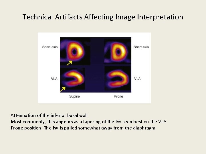Technical Artifacts Affecting Image Interpretation Attenuation of the inferior basal wall Most commonly, this