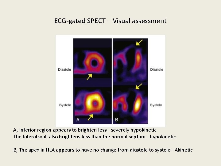 ECG-gated SPECT – Visual assessment A, Inferior region appears to brighten less - severely
