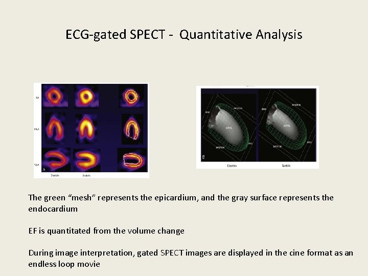 ECG-gated SPECT - Quantitative Analysis The green “mesh” represents the epicardium, and the gray