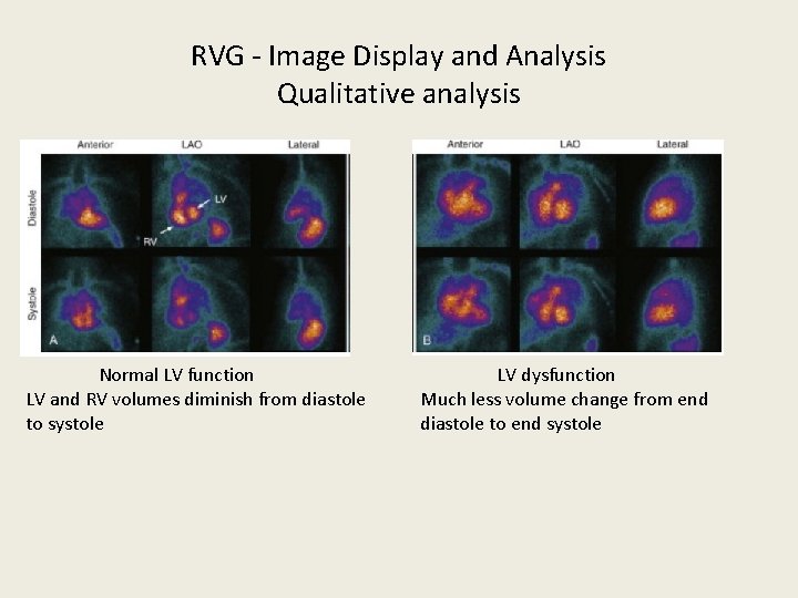 RVG - Image Display and Analysis Qualitative analysis Normal LV function LV dysfunction LV