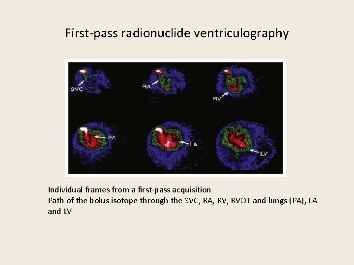 First-pass radionuclide ventriculography Individual frames from a first-pass acquisition Path of the bolus isotope