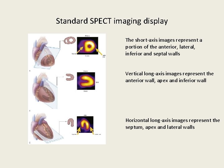 Standard SPECT imaging display The short-axis images represent a portion of the anterior, lateral,