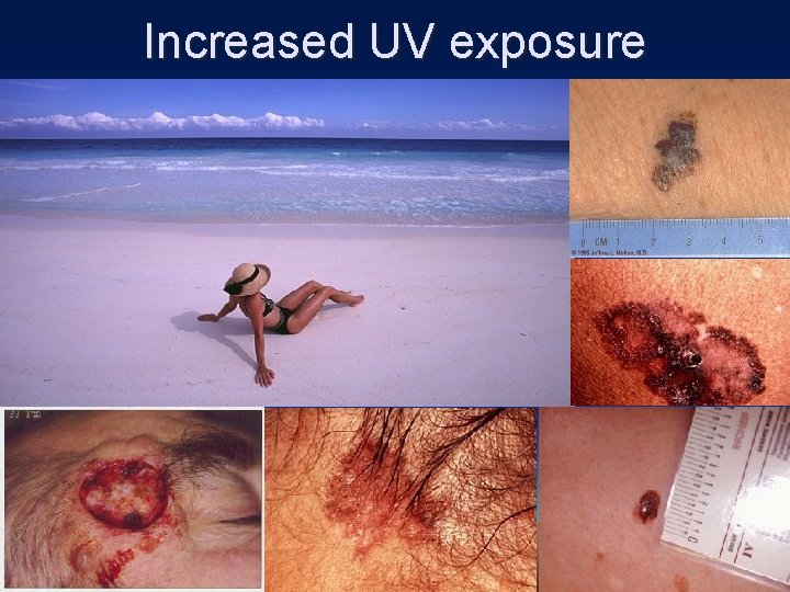 Increased UV exposure 